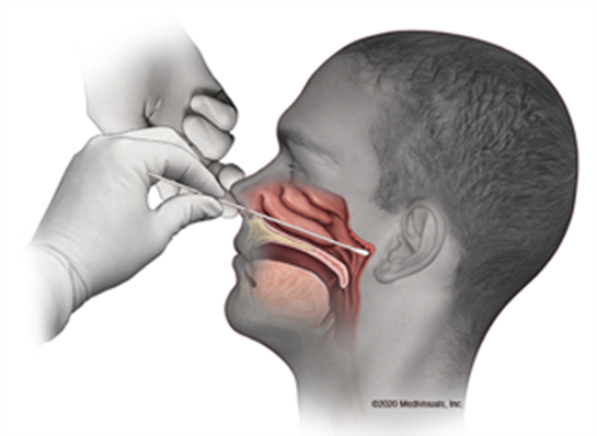Two hands insert a swab into a person's nose